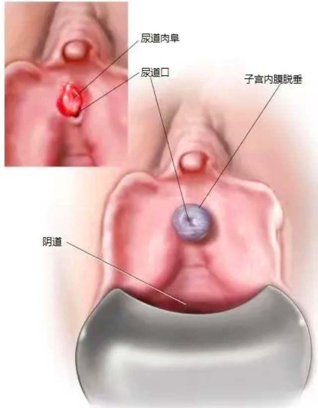难言之痛，关注“尿道肉阜”