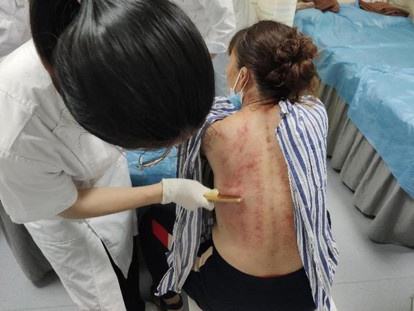 刮痧治疗.jpg