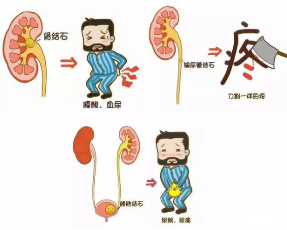“难言之痛”——带您走进泌尿系结石的世界 - 广东省中医院海南医院(海南省中医院、海南省中西医结合医院、海南省中医药研究院)