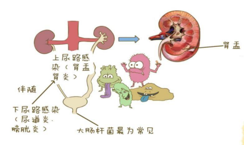 “难言之痛”——带您走进泌尿系结石的世界 - 广东省中医院海南医院(海南省中医院、海南省中西医结合医院、海南省中医药研究院)