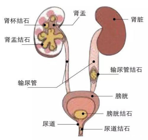 “难言之痛”——带您走进泌尿系结石的世界 - 广东省中医院海南医院(海南省中医院、海南省中西医结合医院、海南省中医药研究院)